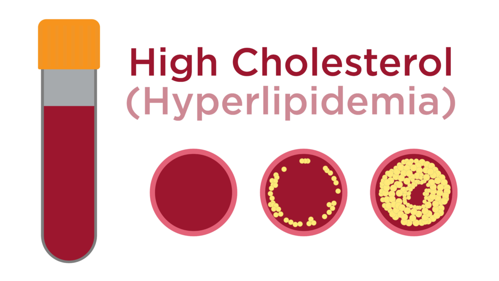 Understanding Hyperlipidemia Symptoms, Complications, and Dietary Tips