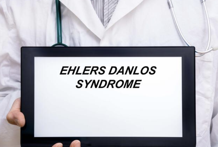 EhlersDanlos Syndrome (EDS) Unmasking the Complex Connective Tissue